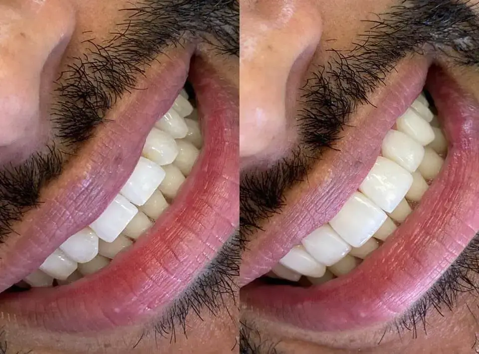 servicio Microdiseño de sonrisa